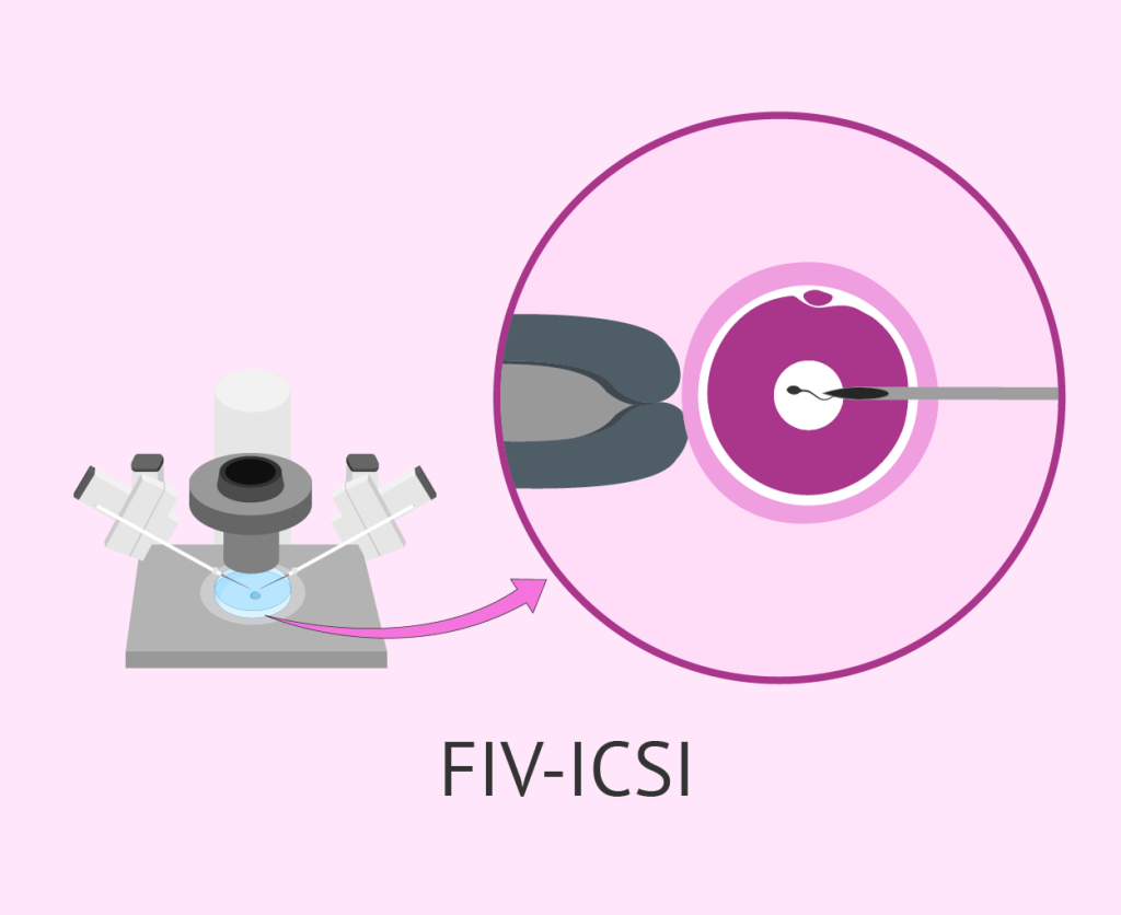 fiv icsi